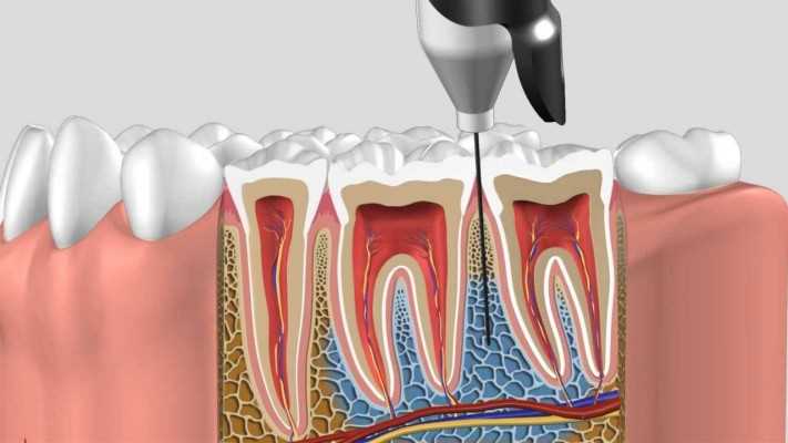 Применение препарата Грандаксин перед анестезией — безопасность и эффективность для комфортного лечения зубов