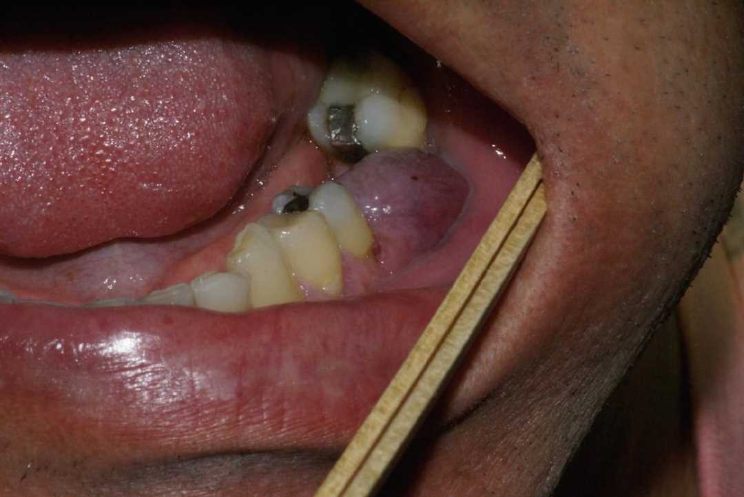 Гранулема после удаления зуба — причины, симптомы и методы лечения