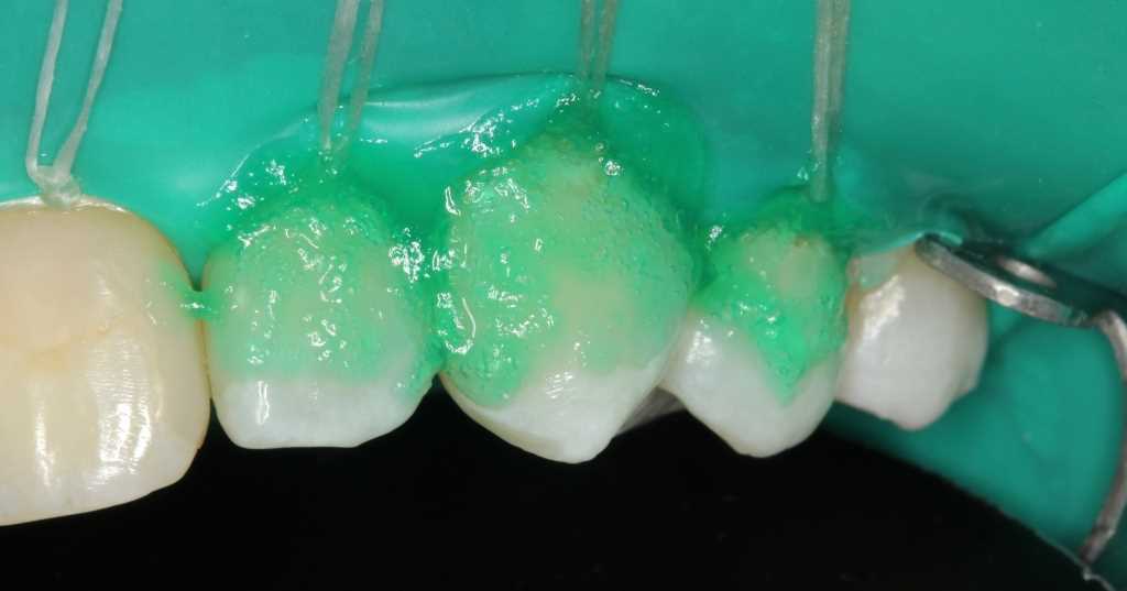 Новый прорыв в стоматологии — безболезненное и эффективное лечение кариеса зубов с помощью системы Icon