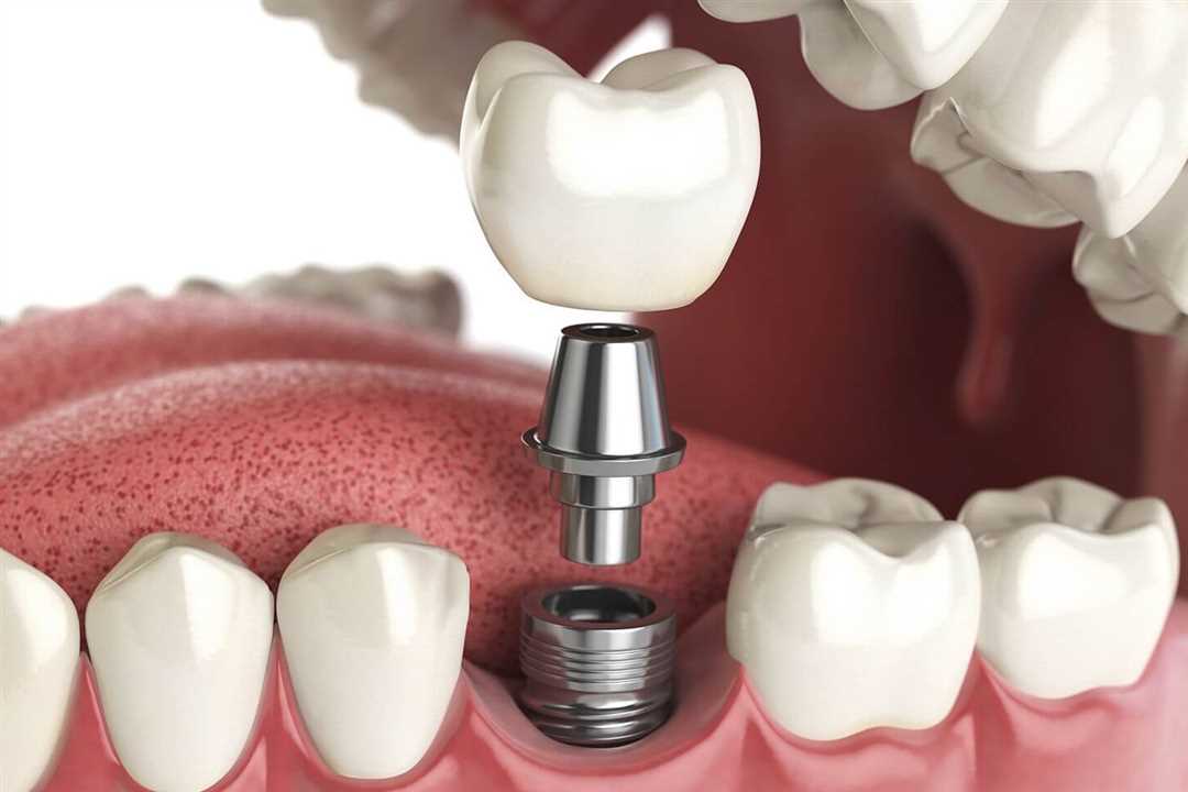 Можно ли ставить имплант сразу после удаления зуба?