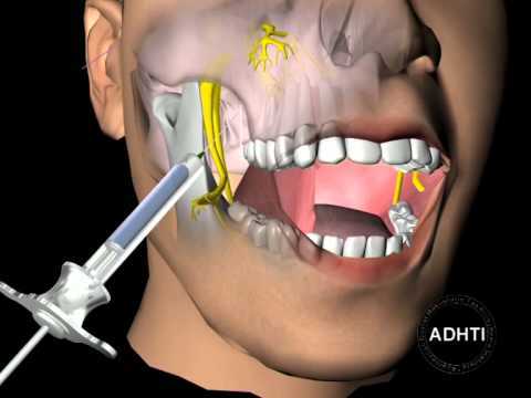 Виды инфильтрационной анестезии в стоматологии