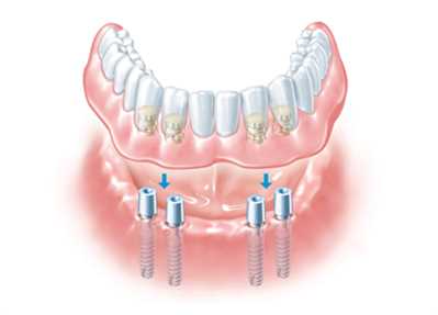 Существуют различные технологии восстановления эстетичности зубного ряда при потере зуба. В их числе – протезирование на имплантах.