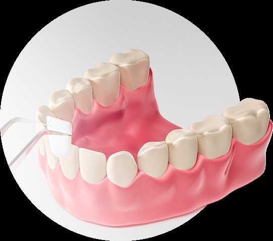 Виды крепления зубных протезов
