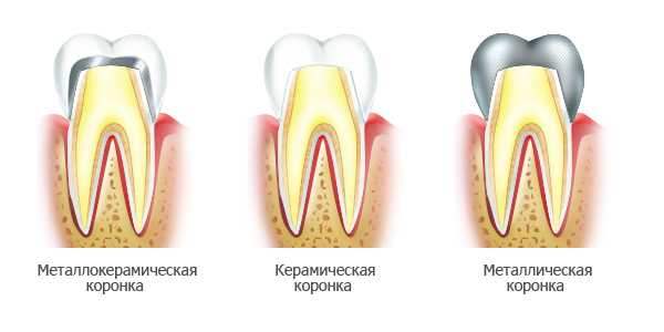 Из каких материалов делают зубные коронки?