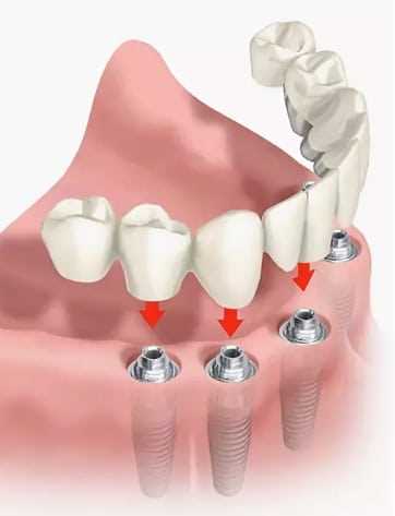 Кабинеты протезирование зубов — адреса и контакты, цены и отзывы, современные технологии и опытные врачи