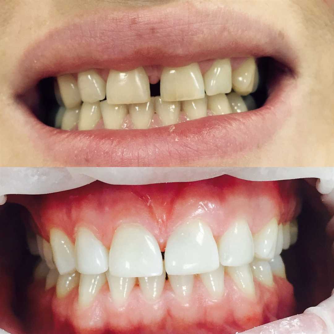 Что можно изменить с помощью реставрации зубов?