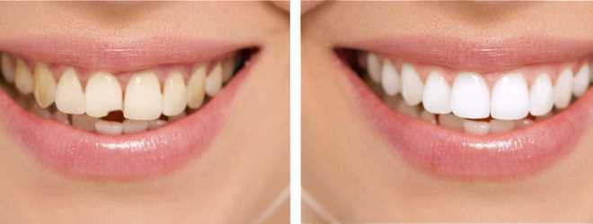 Какие проблемы можно корректировать с помощью эстетической реставрации зубов?