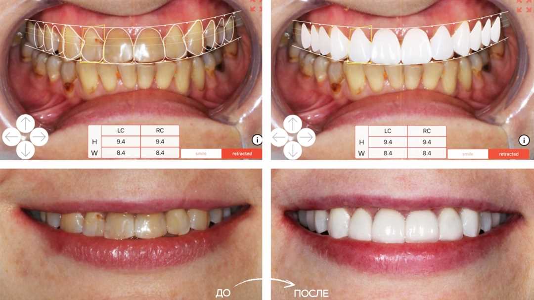 Искусство реставрации зубов — достижение высокого качества