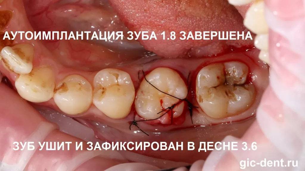 Лечение зубов под общим наркозом