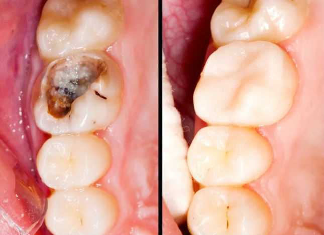 Терапевтическая стоматология все виды лечения зубов