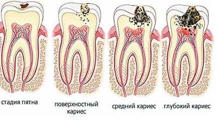 Как правильно осуществляется лечение кариеса зубов и какие методы применяются в современной стоматологии