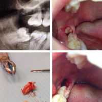 Как происходит удаление зубов?