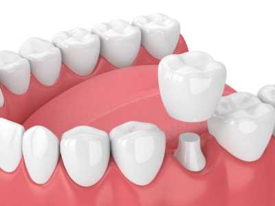Как проходит процедура установки зубных коронок — подробное руководство