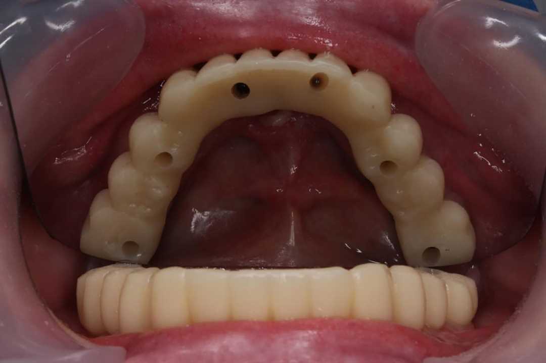 Как выглядит протезирование зубов