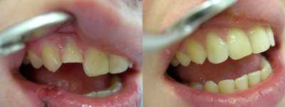 Реставрационное покрытие зубов – что такое художественная или косметическая реставрация