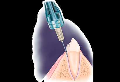 Анестезия при лечении зубов — разновидности и выбор метода обезболивания