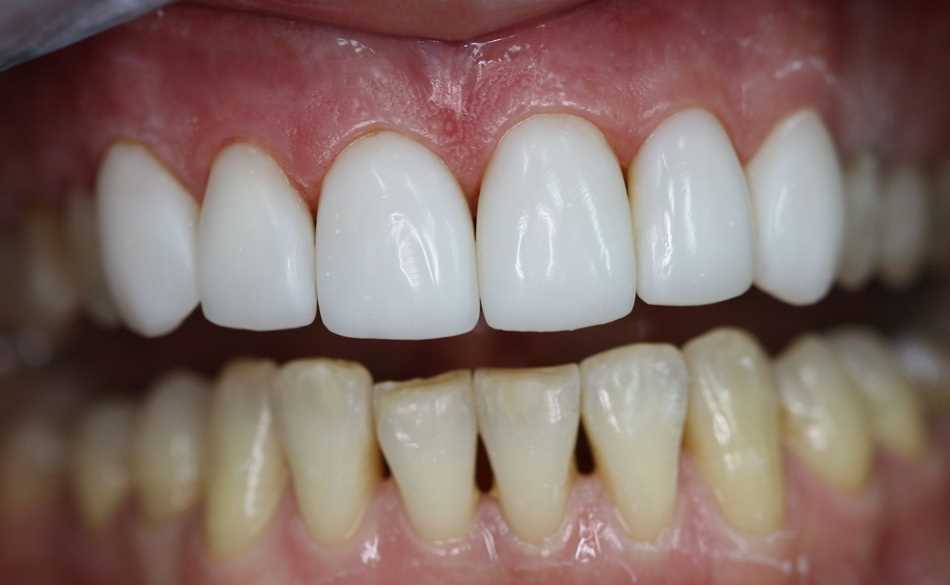 Материалы, применяемые при реставрации зубов — все, что вам нужно знать
