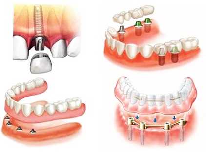 Какие существуют виды протезов зубов?