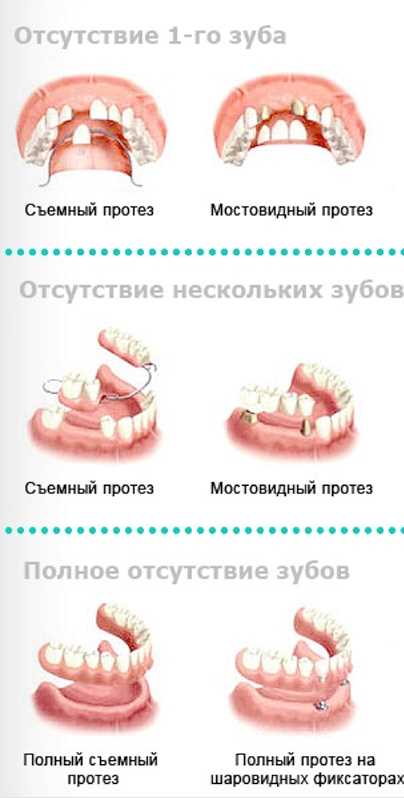 Какое протезирование зубов