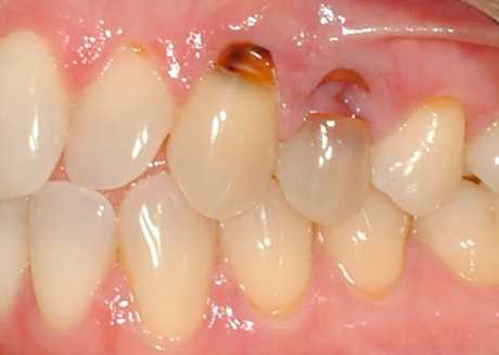 В каких случаях удалять зуб при кариесе корня?