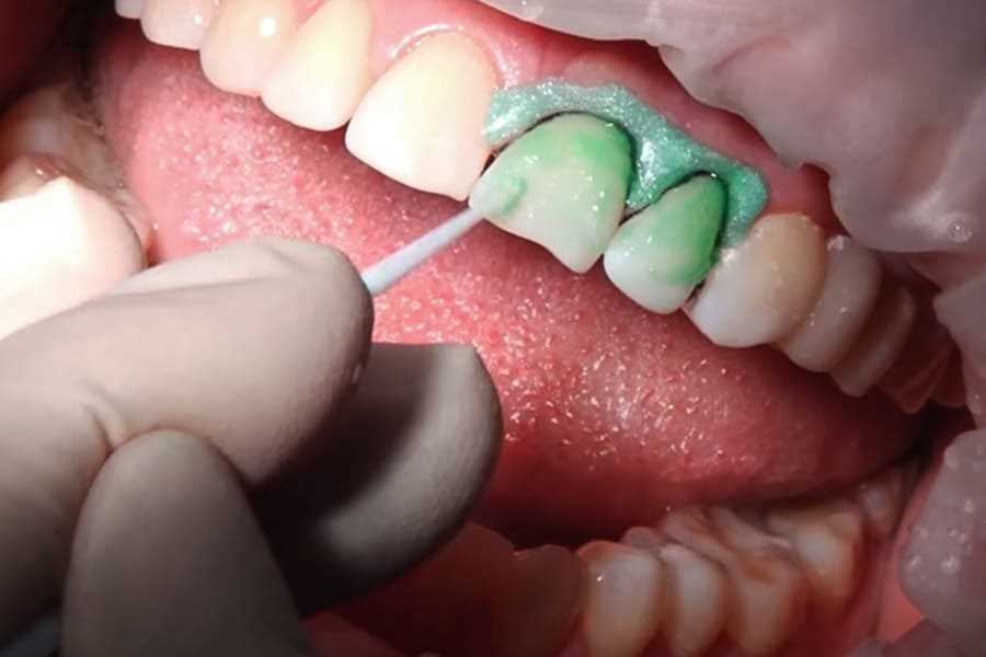 Как самостоятельно лечить кариес без посещения стоматолога — проверенные методы и советы