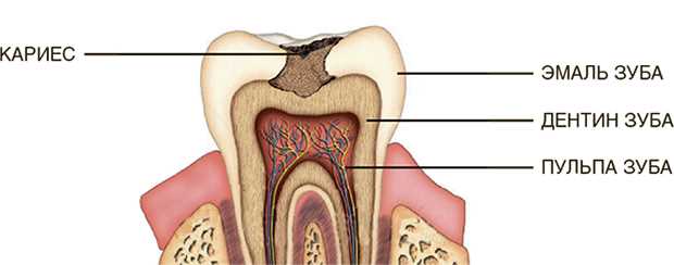 Когда показано лечение кариеса зубов?