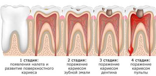 Прогрессивные методы лечения кариеса — от диагностики до сохранения здоровья зубов