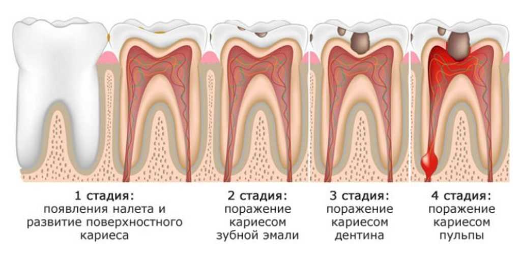 Кариес цемента зуба – основные клинические проявления