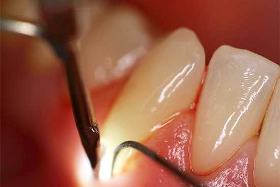 Кариес цемента — симптомы, диагностика и методы лечения в стоматологии
