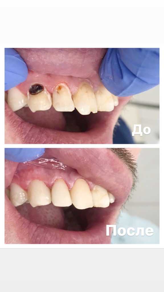 Кариес зубов реставрация