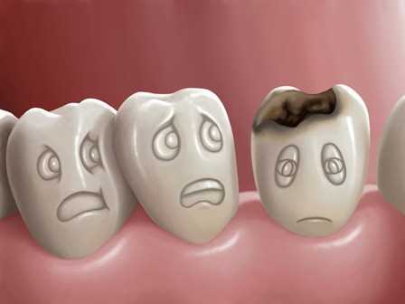 75. Значение зубного налета в возникновении кариесогенной ситуации
