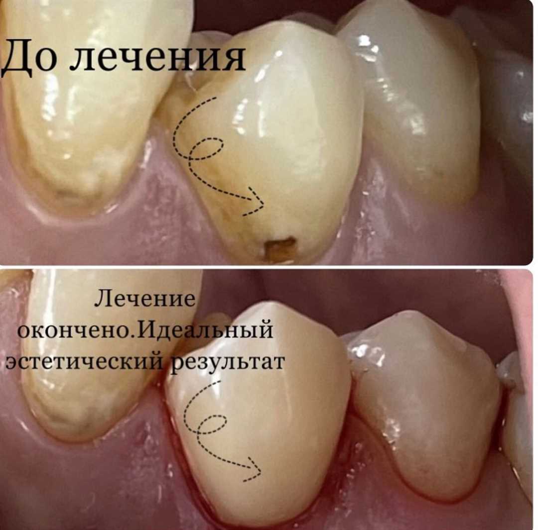 Кариесогенность зубного налета