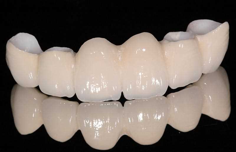Основные преимущества керамических коронок зубов