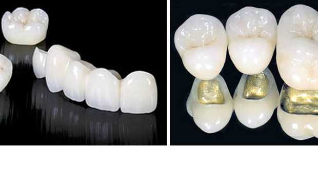 Керамическая зубная коронка — надежность, эстетика и функциональность