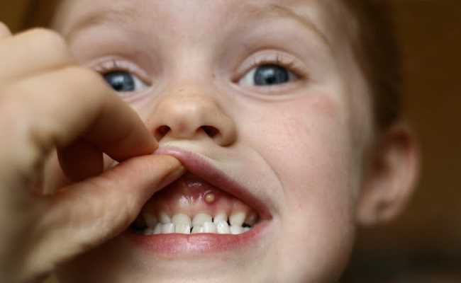 Кисты, образующиеся при неправильном прорезывании зубов