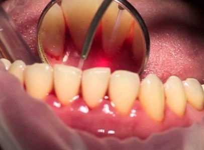 Последствия кисты зуба