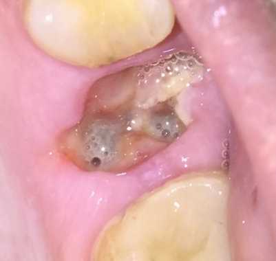 Причины возникновения кисты после удаления зуба