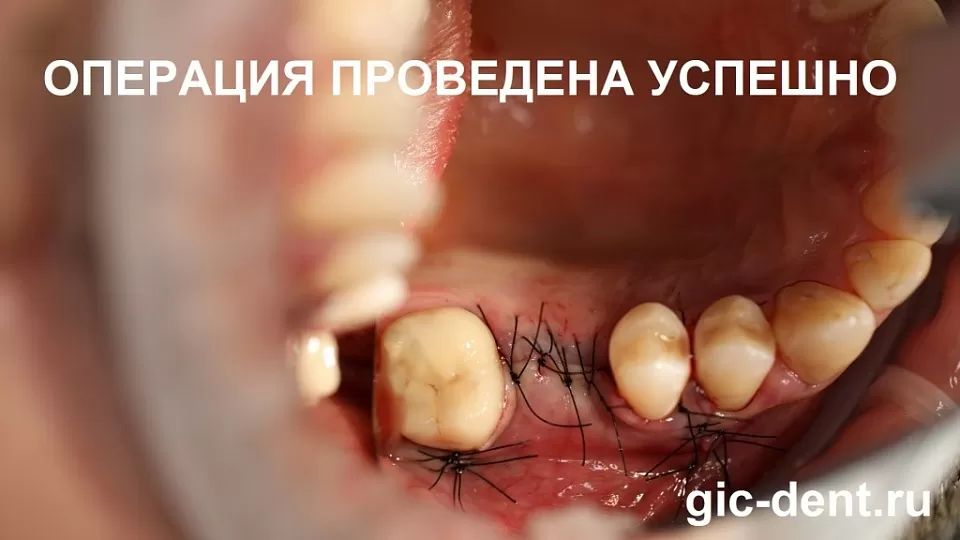 Киста до и после имплантации зуба