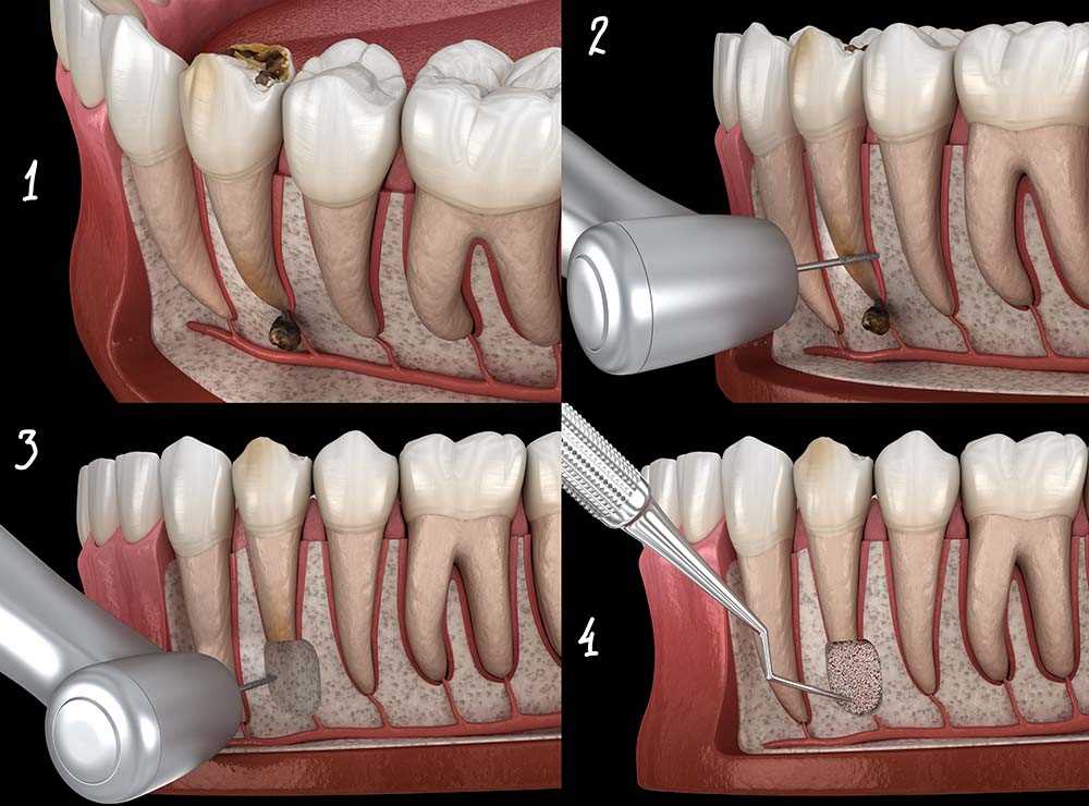 Киста удаление зуба имплант