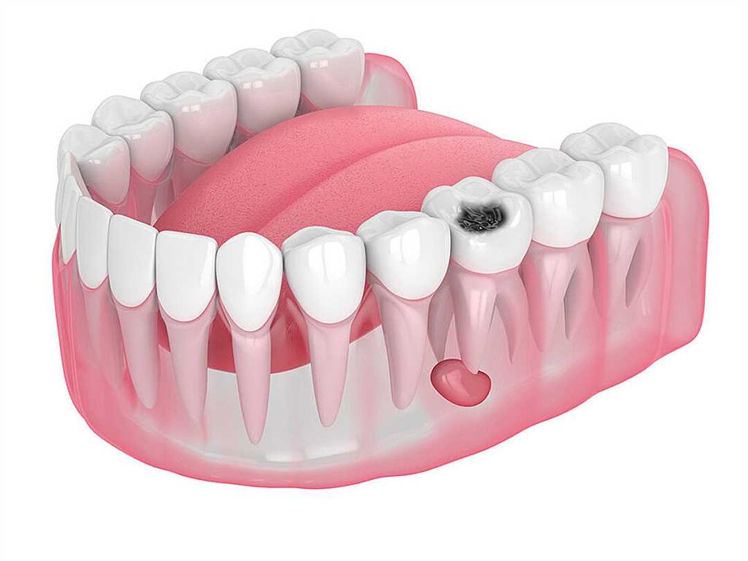 Современные методики удаления кисты зуба