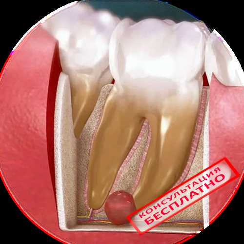 Киста зуба — причины образования, симптомы и методы лечения, роль анестезии в процессе