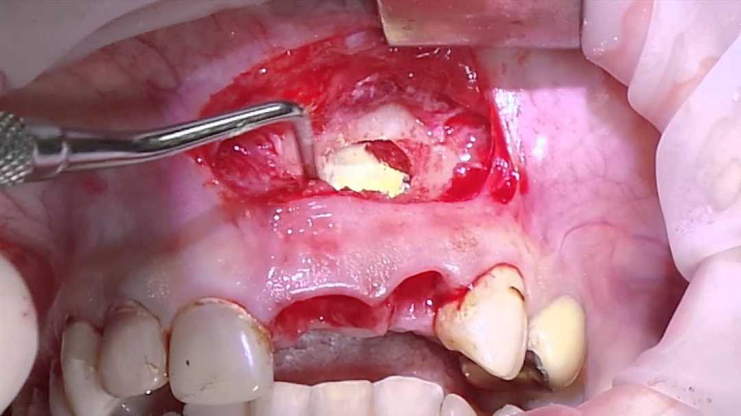 Осложнения при кисте зуба моляров