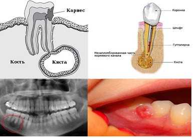 Как киста зуба может повлиять на протезирование — симптомы, лечение и последствия