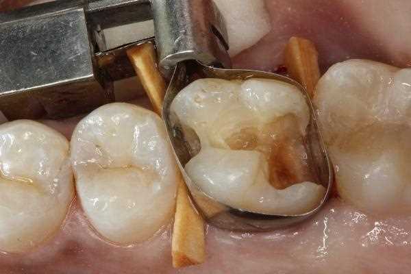 Классы реставрации зубов — основные типы и методы восстановления структуры зубов
