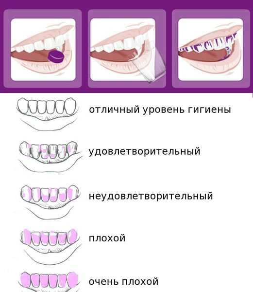 Профилактика образования зубного налёта