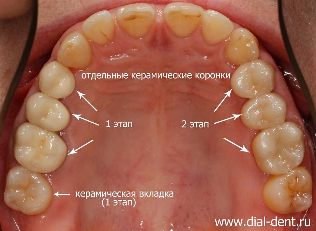 Метод ключа для реставрации жевательных зубов с несохраненной анатомией окклюзионной поверхности