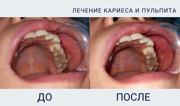 Составление плана комплексного лечения и протезирования зубов
