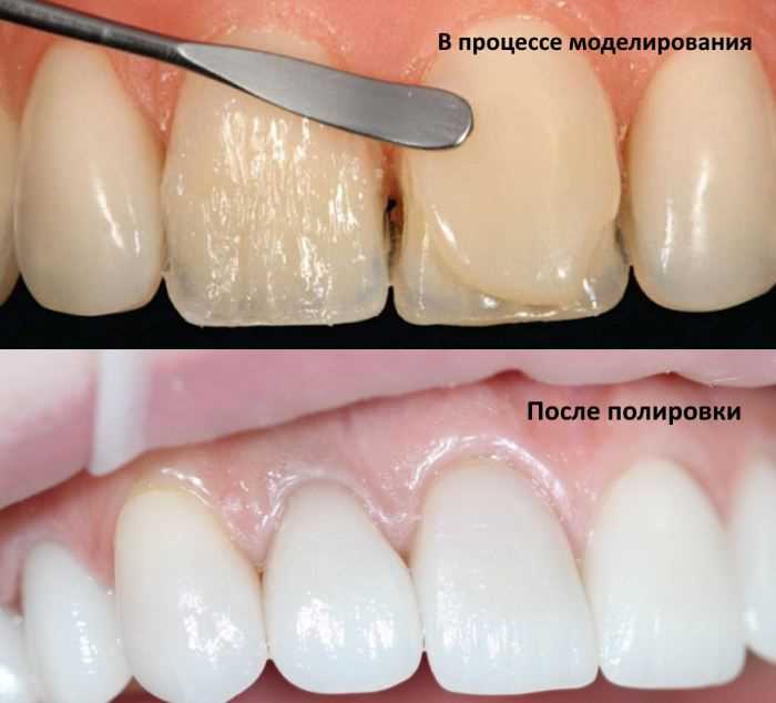 Композитные материалы для эстетической реставрации передней группы зубов — отбеливание, восстановление и реконструкция