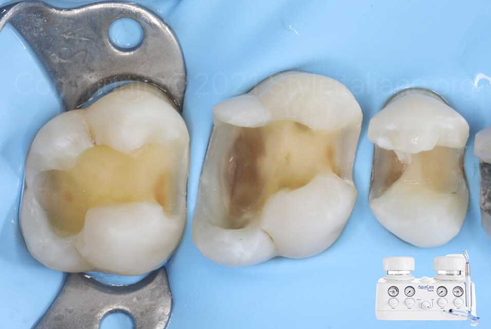 Композитный материал для реставрации боковых зубов