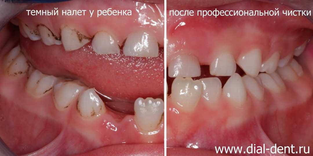 Разновидности зубного налета. Причины образования и методы борьбы.